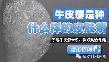 什么是寻常型牛皮癣